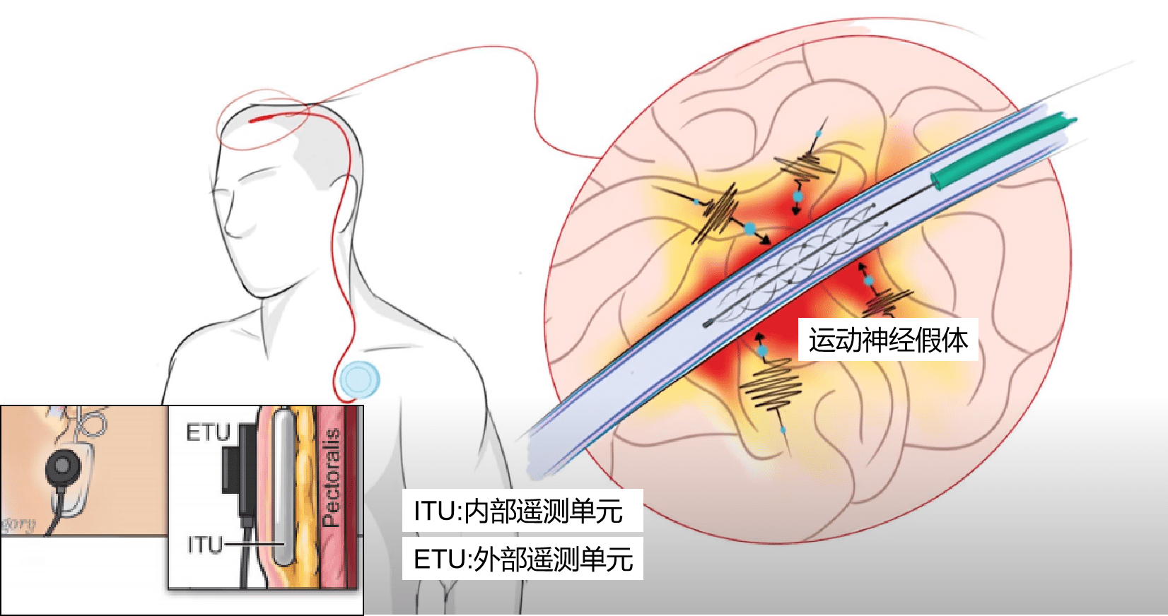 脑机接口“解冻”渐冻症患者控制能力