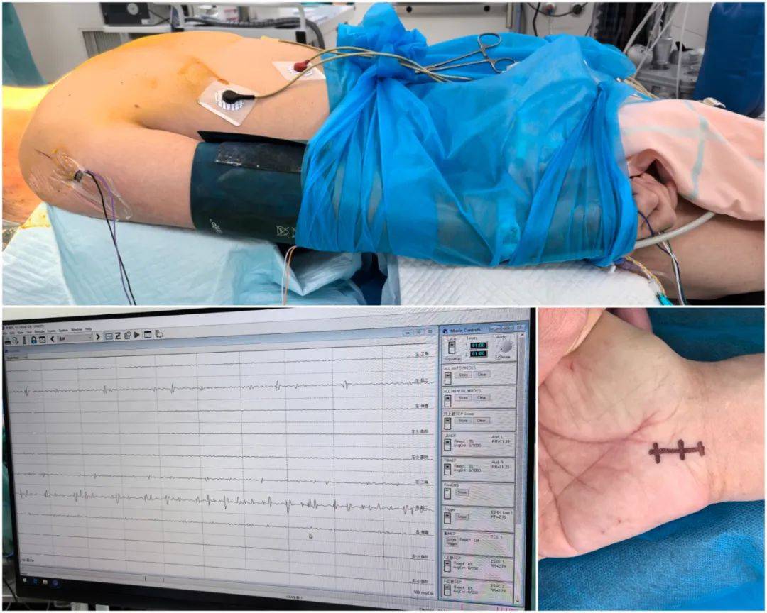 西部首例！脊髓损伤患者脑机接口手术于四川大学华西医院顺利完成