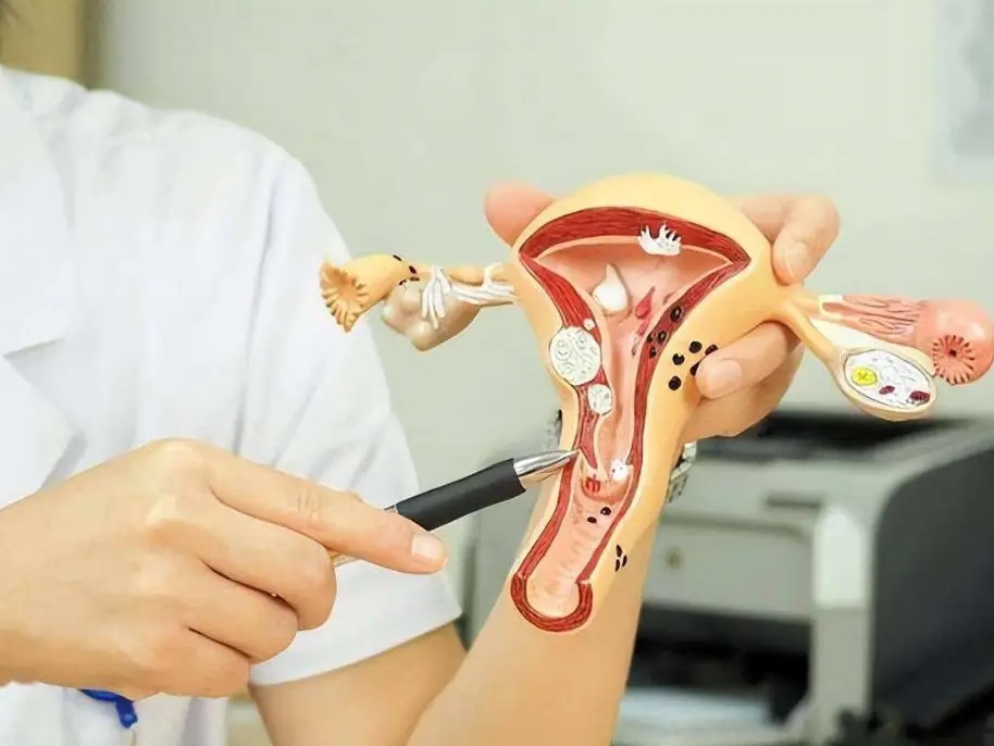 中国科学家找到治疗子宫腺肌症新靶点新方法